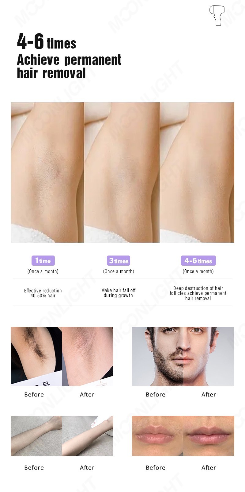 laser hair removal D2 (12)