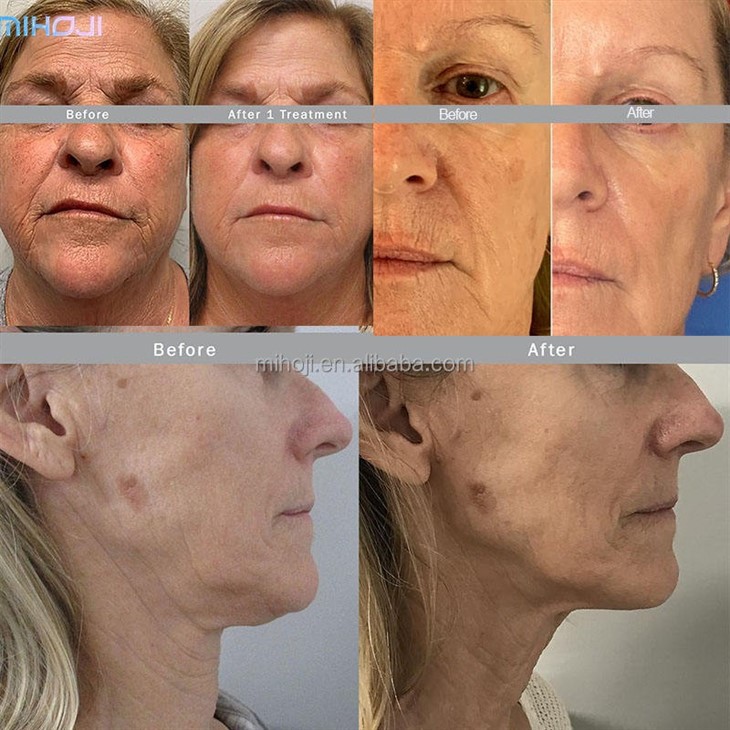 Advantages Of Morpheus 8 Machine